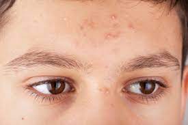 pimples लक्षण