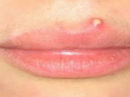 lips पर मुंहासे क्यों होते है उसके उपाय