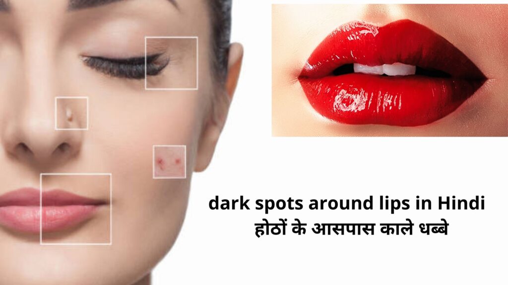 dark spots around lips in Hindi - होठों के आसपास काले धब्बे