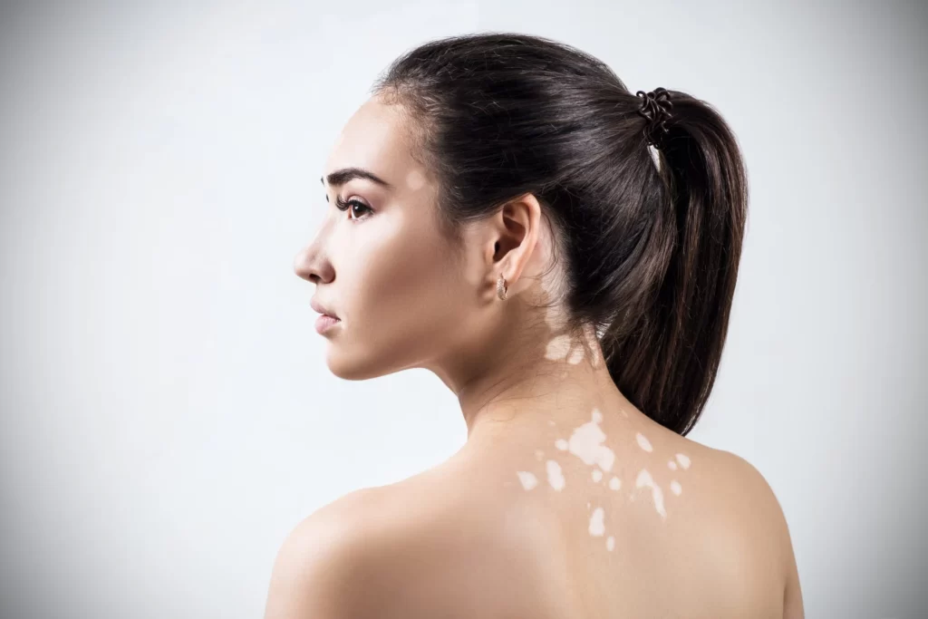 Vitiligo विटिलिगो फेस स्टिग्मा वाले नाइजीरियाई