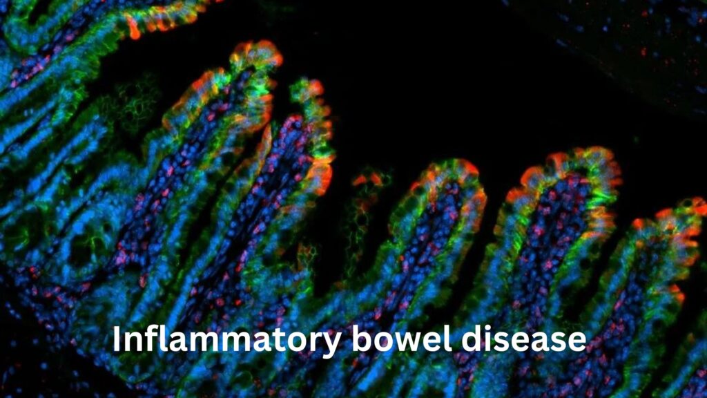 Inflammatory bowel disease In Hindi