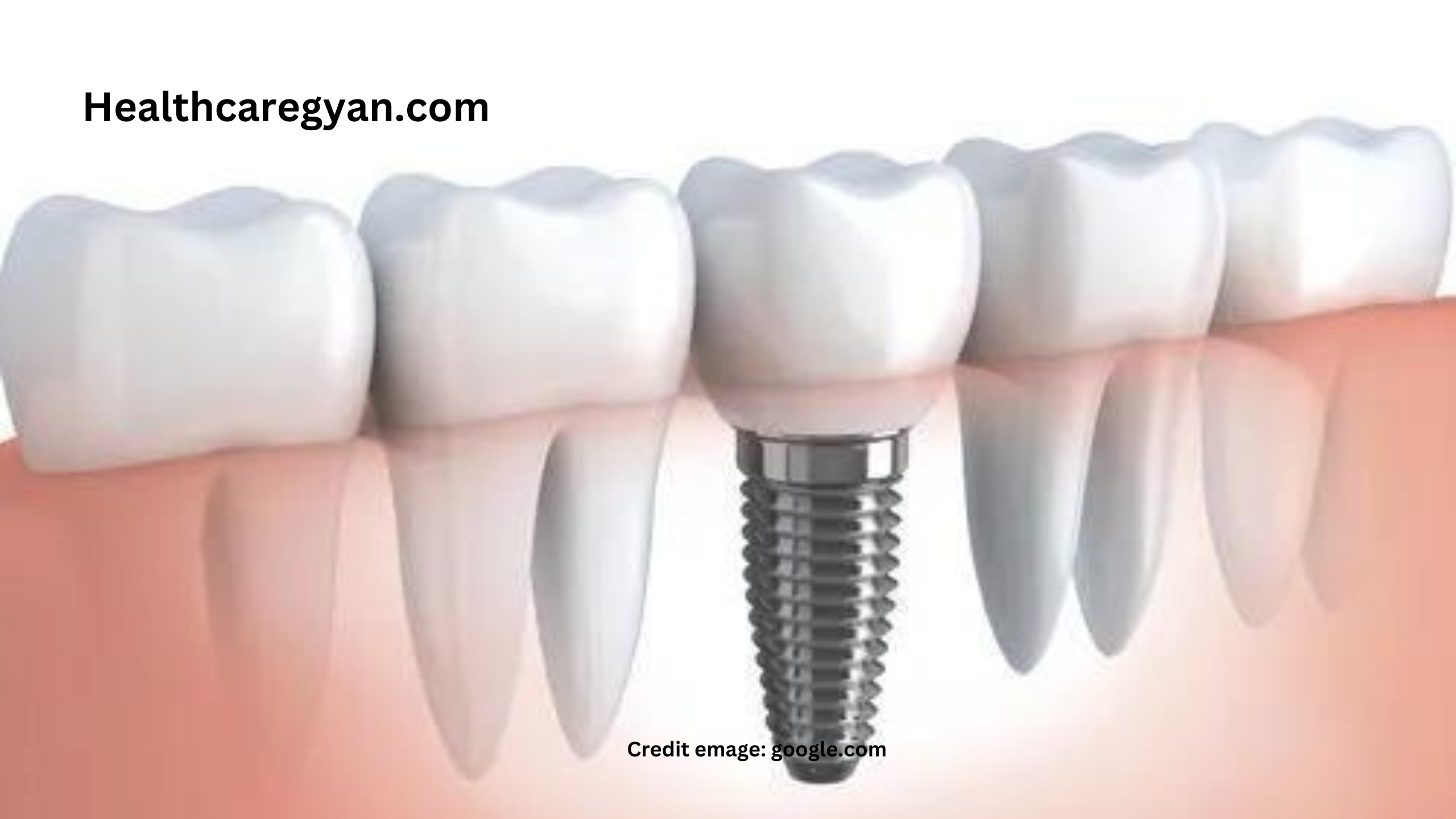 Dental implant