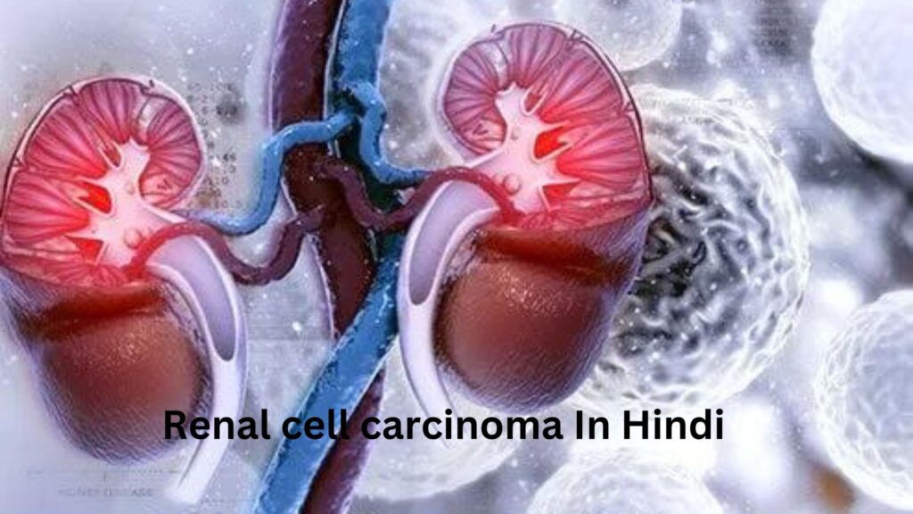 Renal cell carcinoma In Hindi