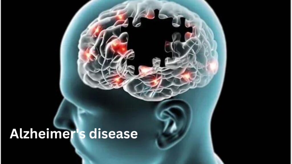 Alzheimer's disease