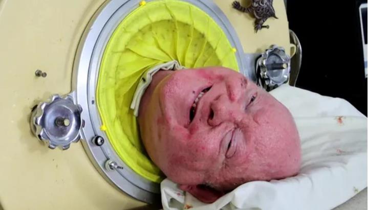 Story Of The Man In The Iron Lung The Man Who Spent 70 Years Infected With Polio Dies