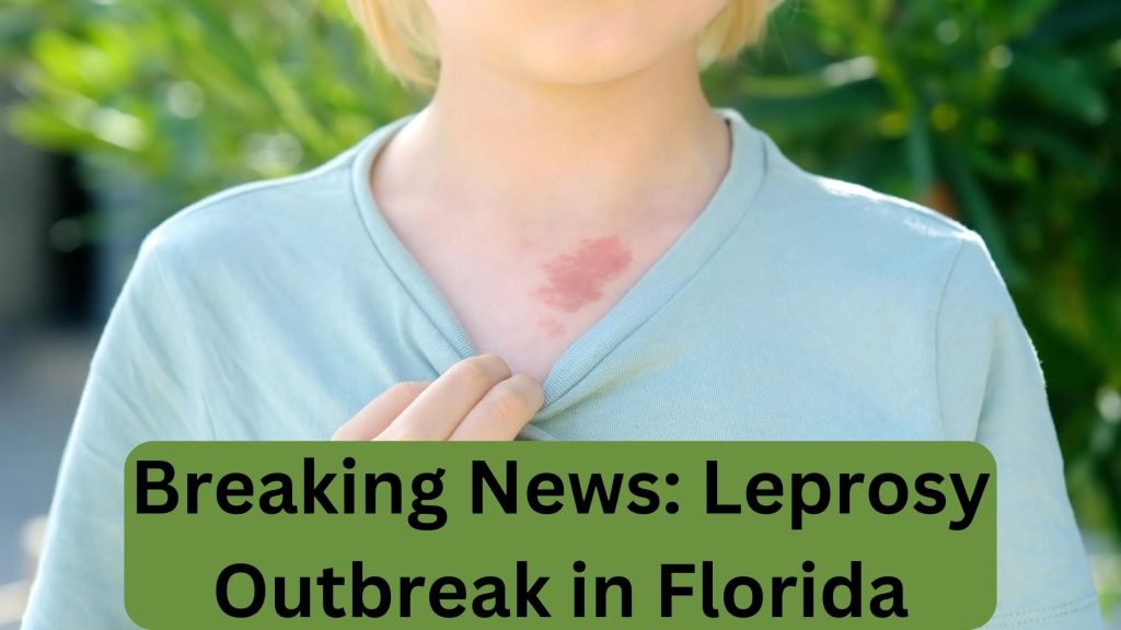 Breaking News: Leprosy Outbreak in Florida