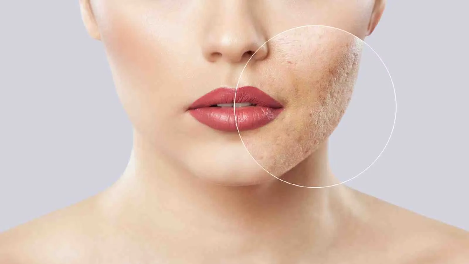 How Can You Get Your Acne Scars to Go Away? 