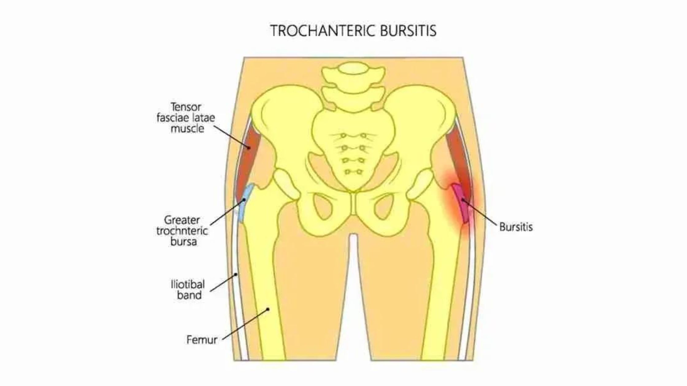 What Causes Hip Pain And How Can You Relieve It?