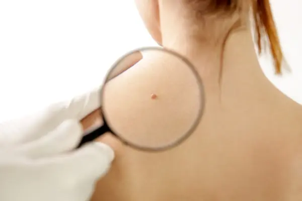 How to Remove Skin Tags, According to Dermatologists